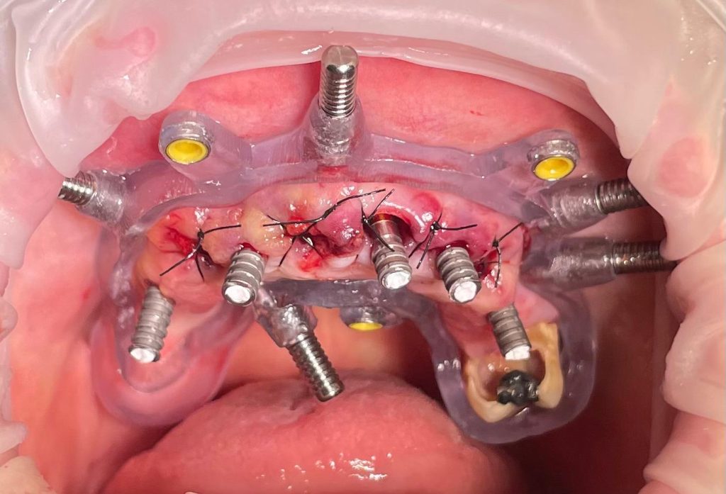 Riabilitazione Immediata Arcata Superiore - 12