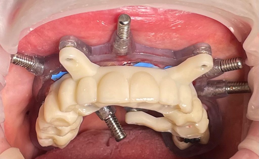Riabilitazione Immediata Arcata Superiore - 13