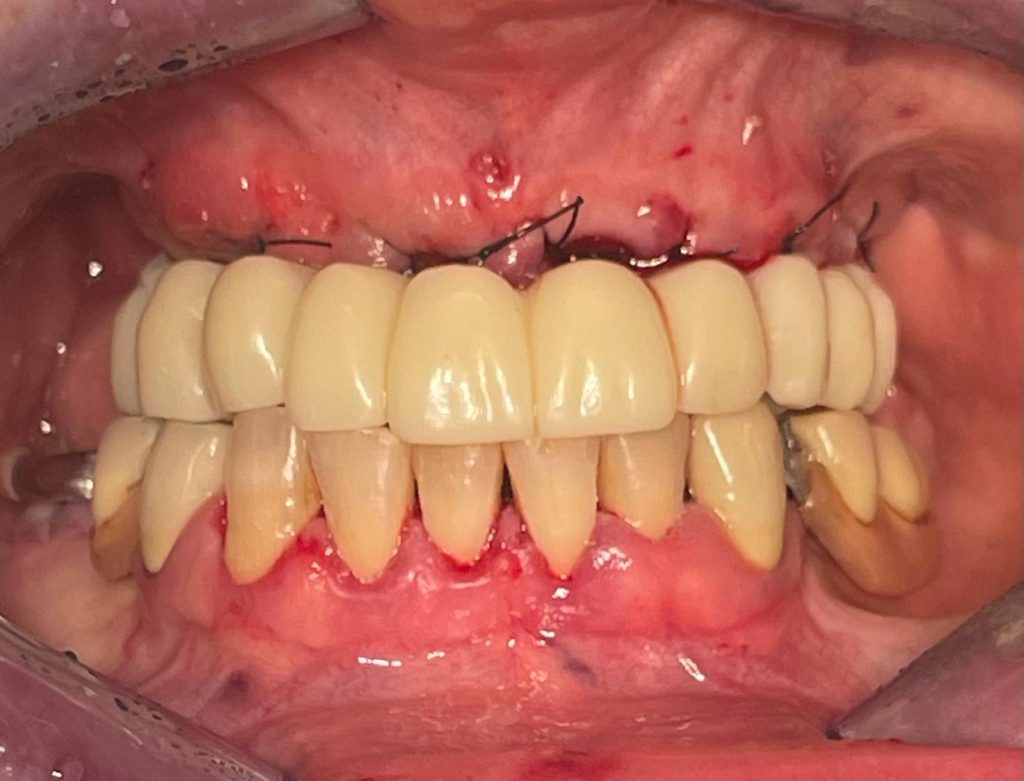 Riabilitazione Immediata Arcata Superiore - 14