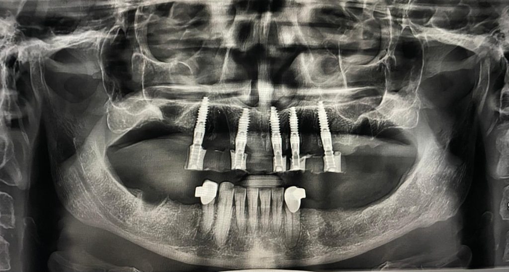 Riabilitazione Immediata Arcata Superiore - 15