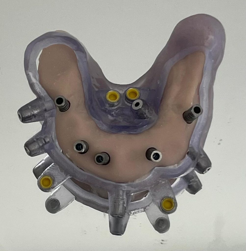 Riabilitazione Immediata Arcata Superiore - 3