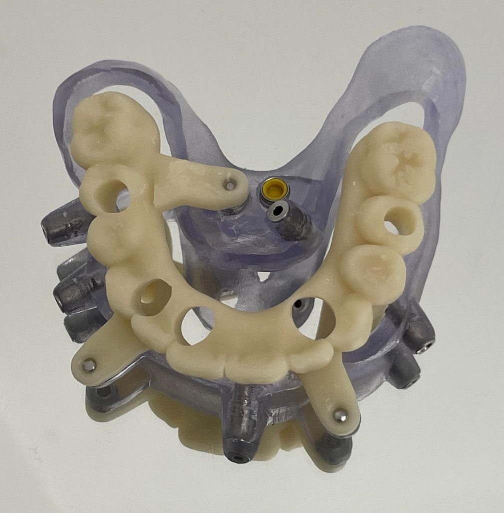 Riabilitazione Immediata Arcata Superiore - 4