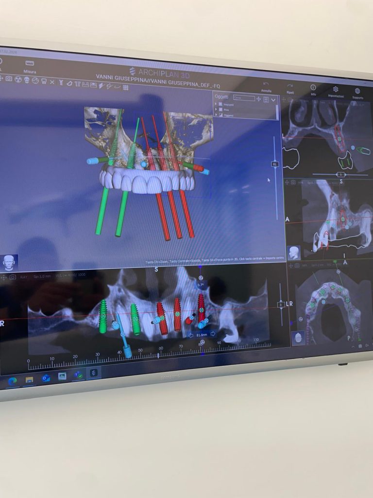 Riabilitazione Immediata Arcata Superiore - 5