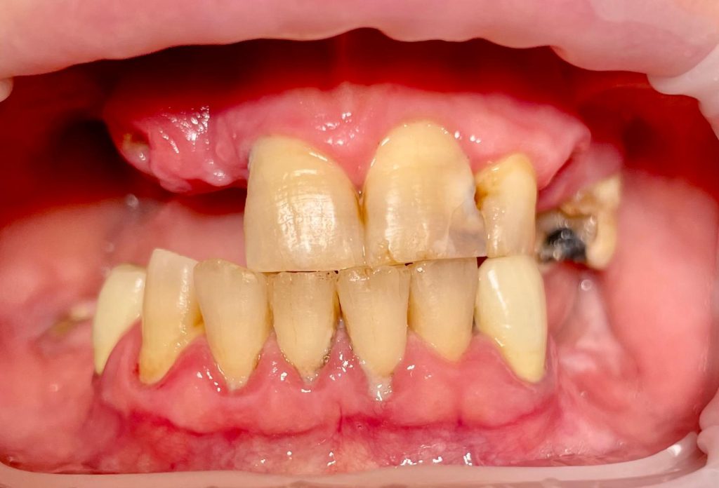 Riabilitazione Immediata Arcata Superiore - 6