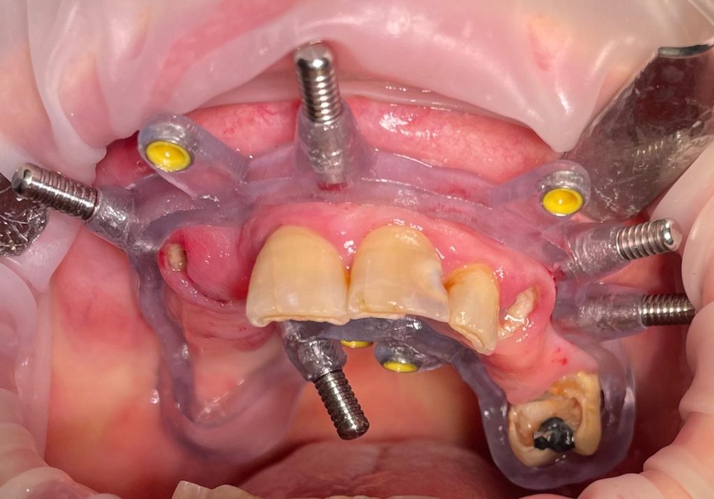 Riabilitazione Immediata Arcata Superiore - 7