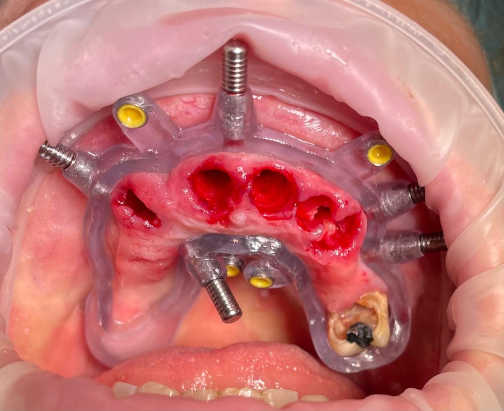Riabilitazione Immediata Arcata Superiore - 8