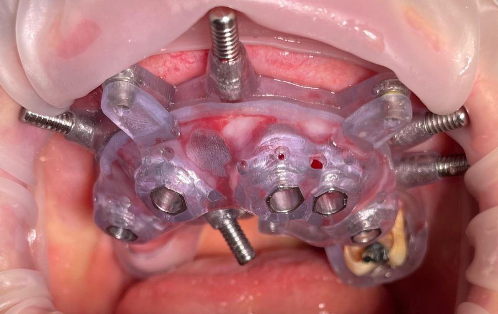 Riabilitazione Immediata Arcata Superiore - 9