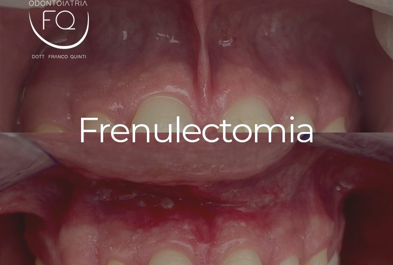 Frenulectomia - 06 agosto