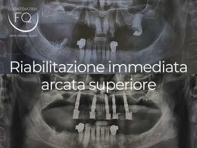 Riabilitazione immediata arcata superiore