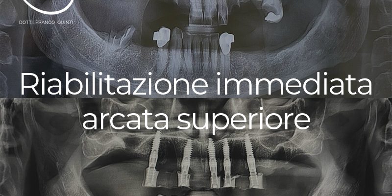 Riabilitazione Immediata Arcata Superiore - 27 agosto