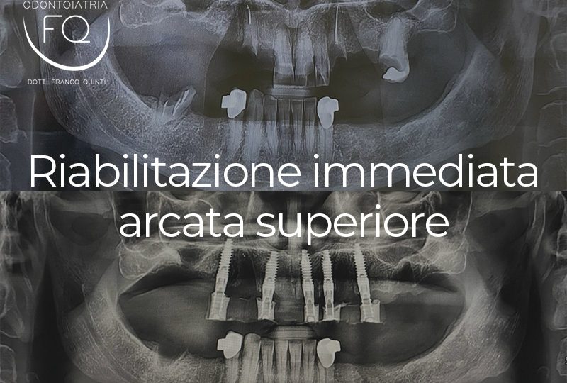 Riabilitazione Immediata Arcata Superiore - 27 agosto