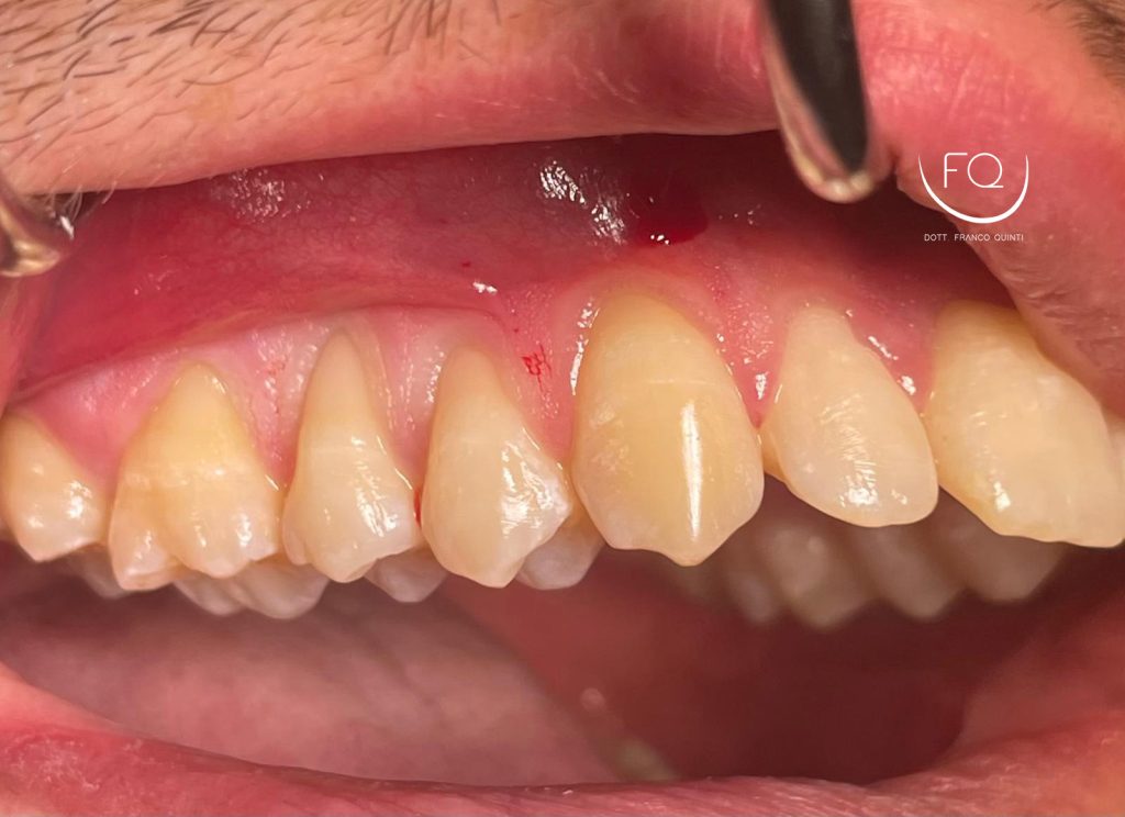 Chirurgia mucogengivale - 1