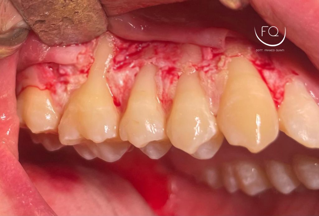 Chirurgia mucogengivale - 2