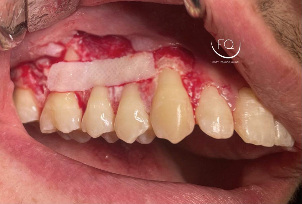 Chirurgia mucogengivale - 3