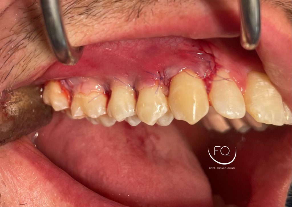 Chirurgia mucogengivale - 4