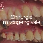 Chirurgia mucogengivale - 18 settembre