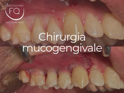 Chirurgia mucogengivale