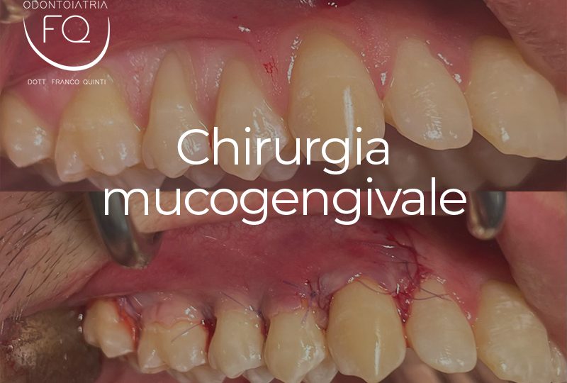 Chirurgia mucogengivale - 18 settembre
