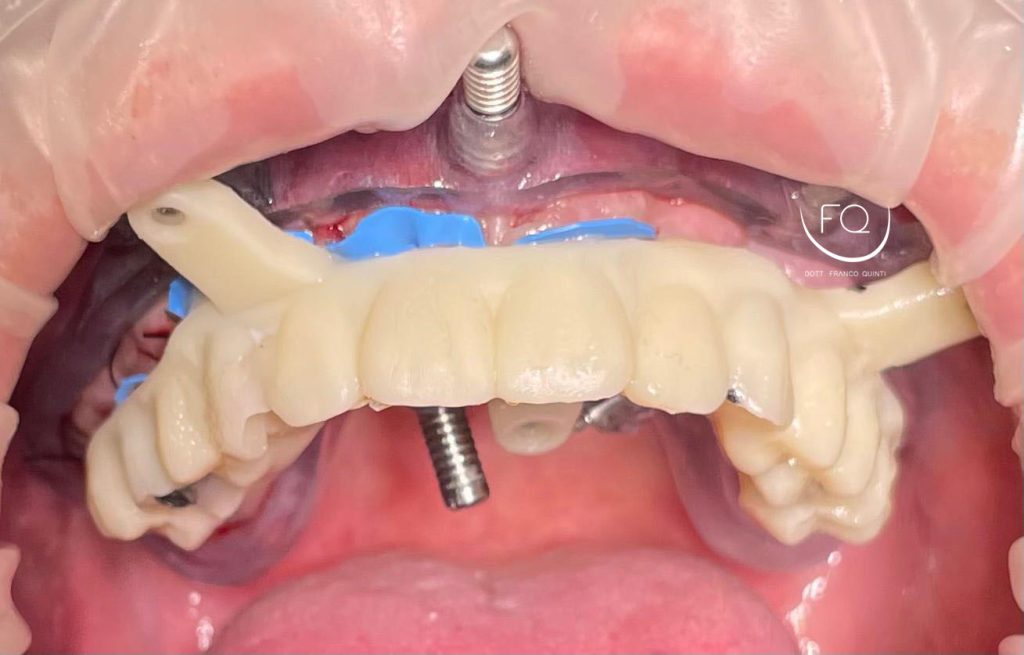 Chirurgia Computer Guidata - 10