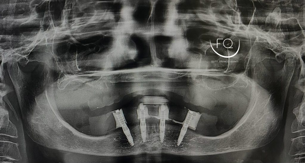 Riabilitazione Arcata Inferiore - 10