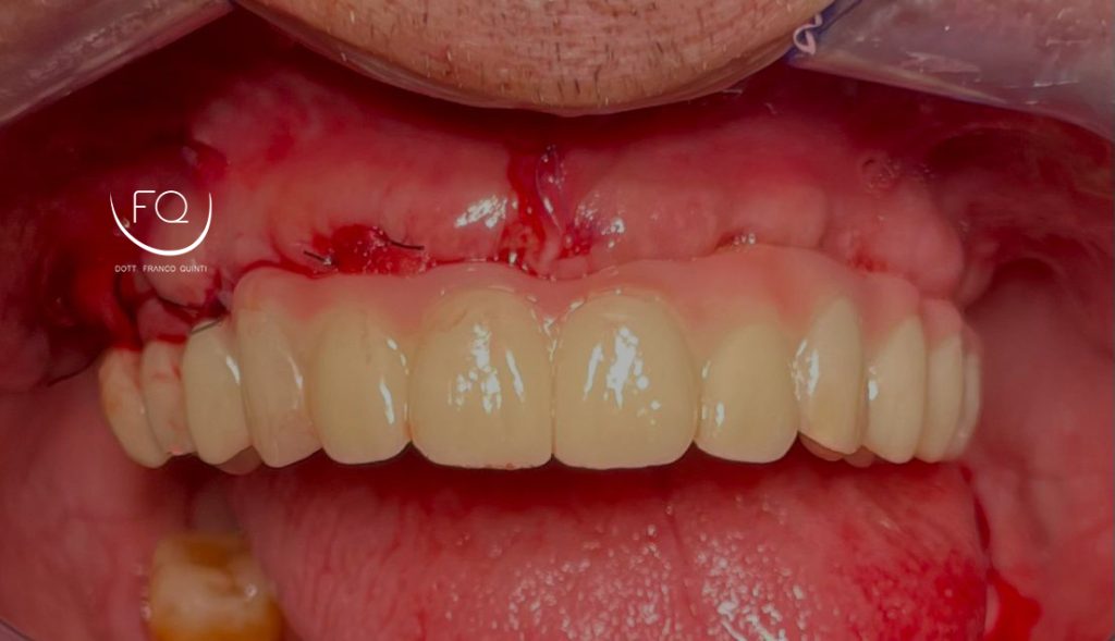 Chirurgia Computer Guidata - 11