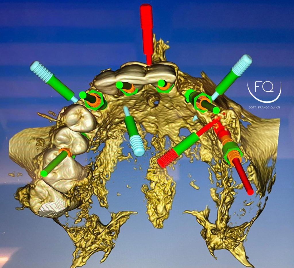 Chirurgia Computer Guidata - 12