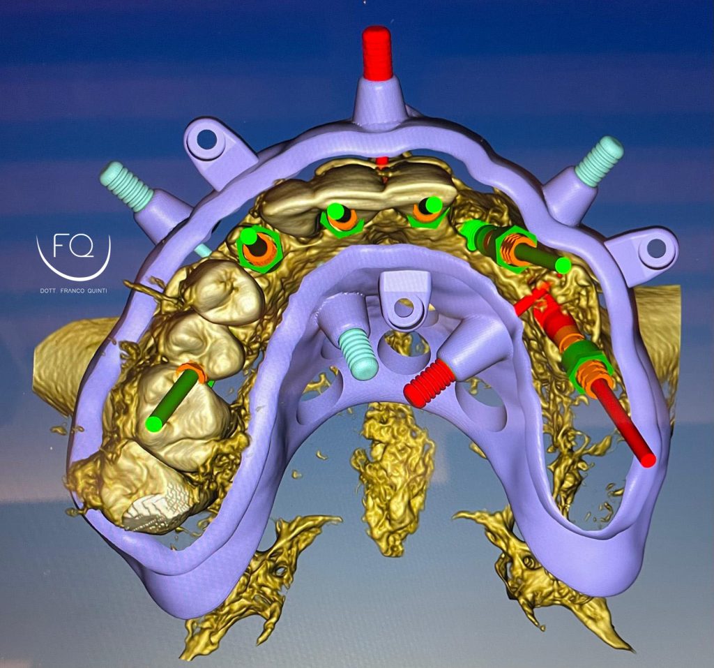 Chirurgia Computer Guidata - 13