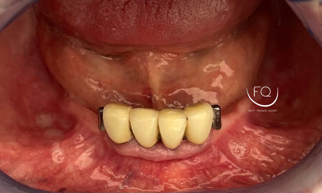 Riabilitazione Arcata Inferiore - 2