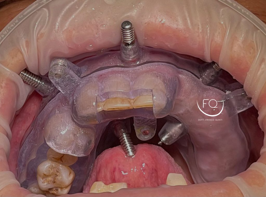 Chirurgia Computer Guidata - 3