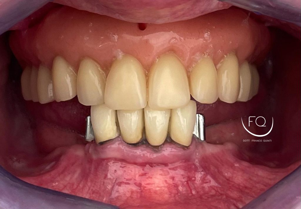 Riabilitazione Arcata Inferiore - 3