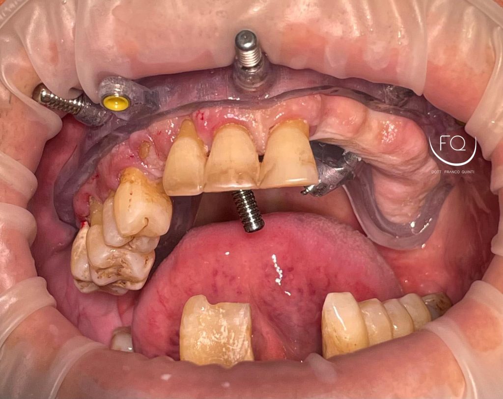 Chirurgia Computer Guidata - 4