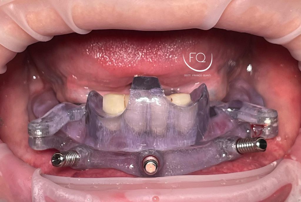 Riabilitazione Arcata Inferiore - 4