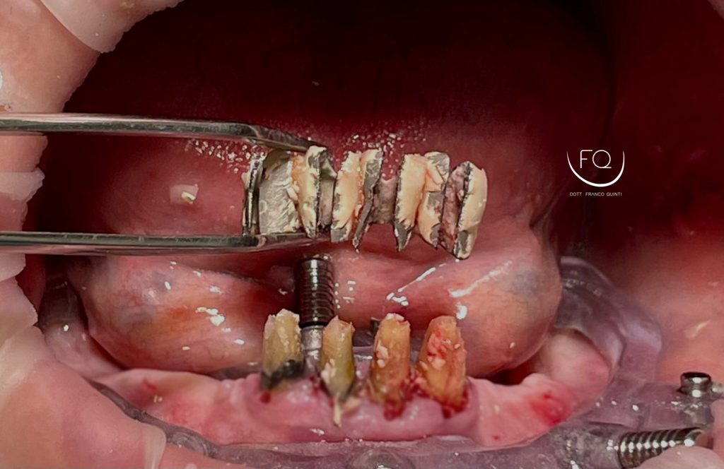Riabilitazione Arcata Inferiore - 5