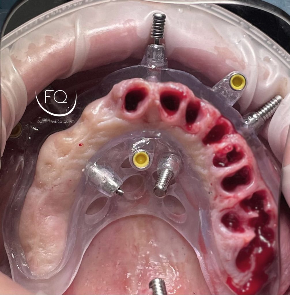 Chirurgia Computer Guidata - 6