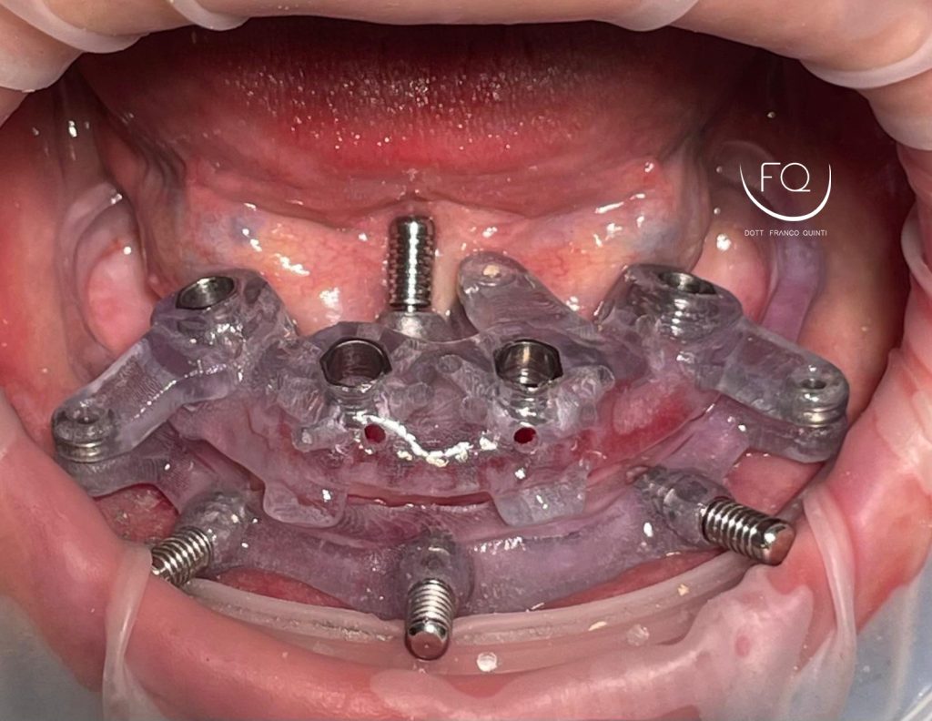 Riabilitazione Arcata Inferiore - 6