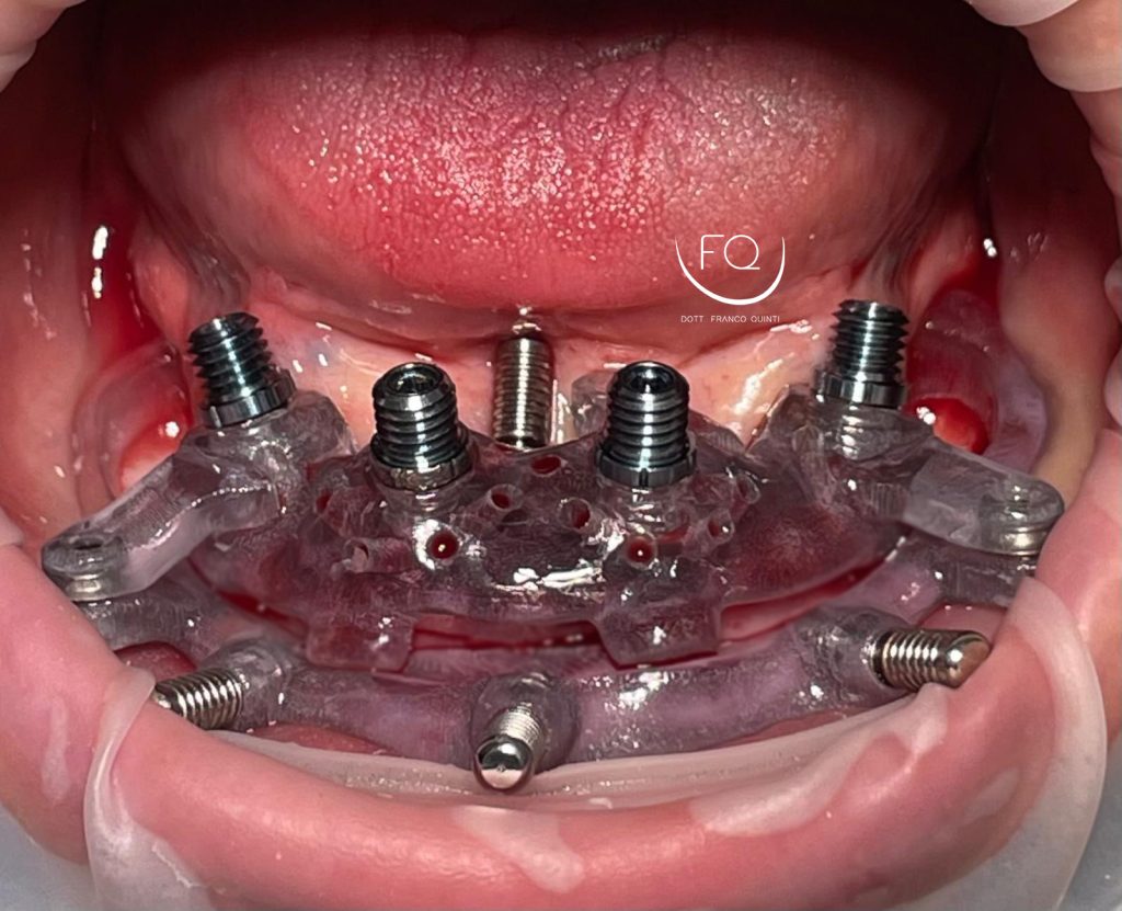 Riabilitazione Arcata Inferiore - 7