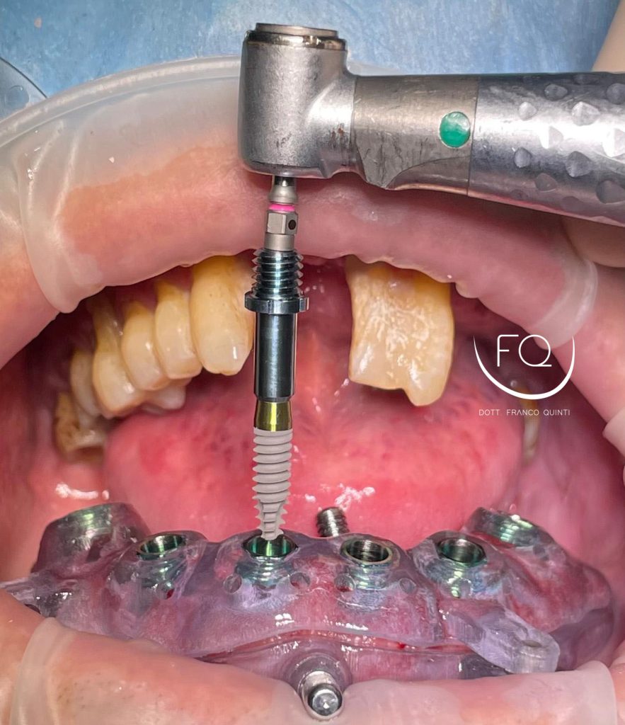 Chirurgia Computer Guidata - 8