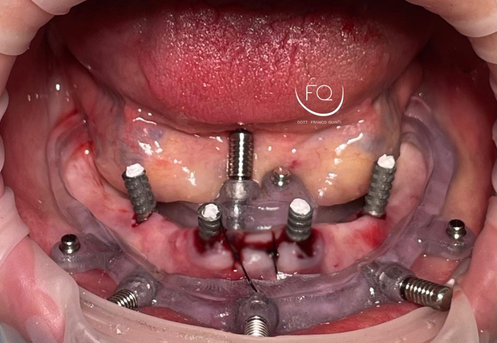 Riabilitazione Arcata Inferiore - 8