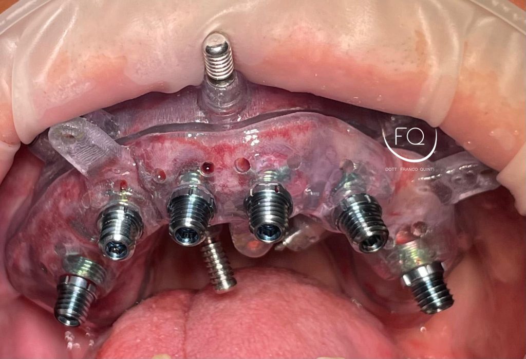 Chirurgia Computer Guidata - 9