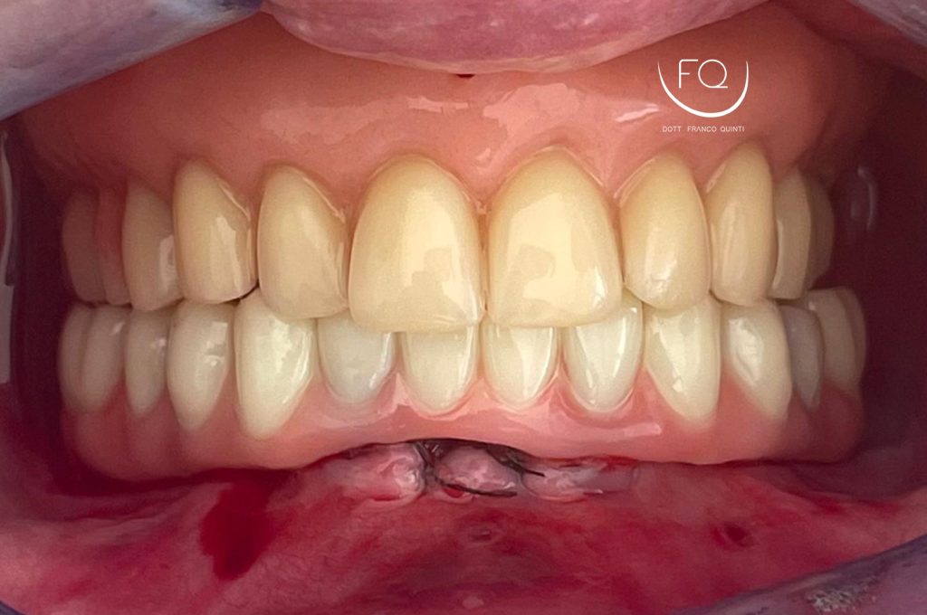 Riabilitazione Arcata Inferiore - 9