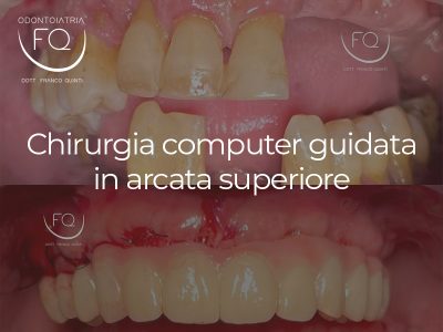 Chirurgia computer guidata in arcata superiore