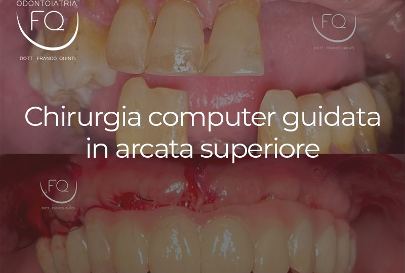 Chirurgia Computer Guidata in arcata superiore - 01 ottobre