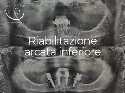 Riabilitazione Arcata Inferiore