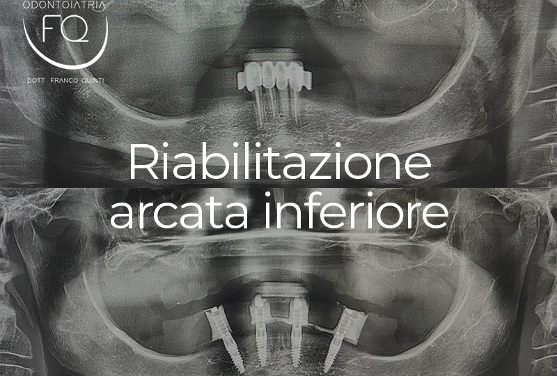 Riabilitazione Arcata Inferiore - 22 ottobre