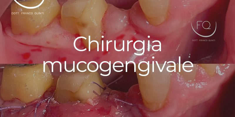 Chirurgia mucogengivale - 03 dicembre