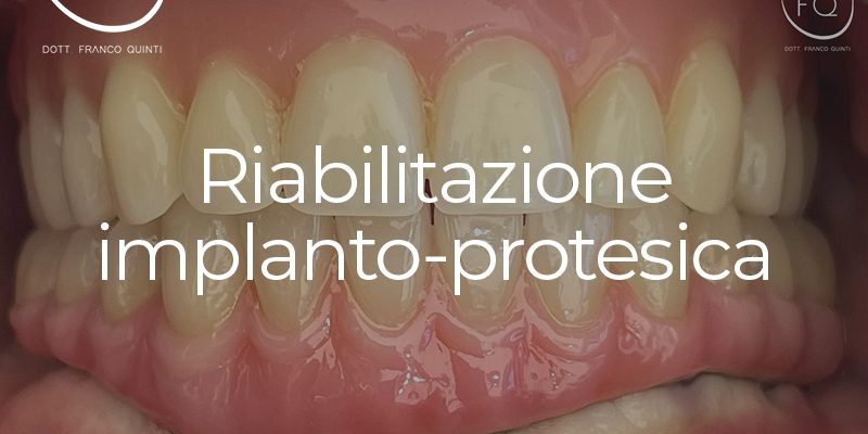 Riabilitazione implanto-protesica - 10 dicembre