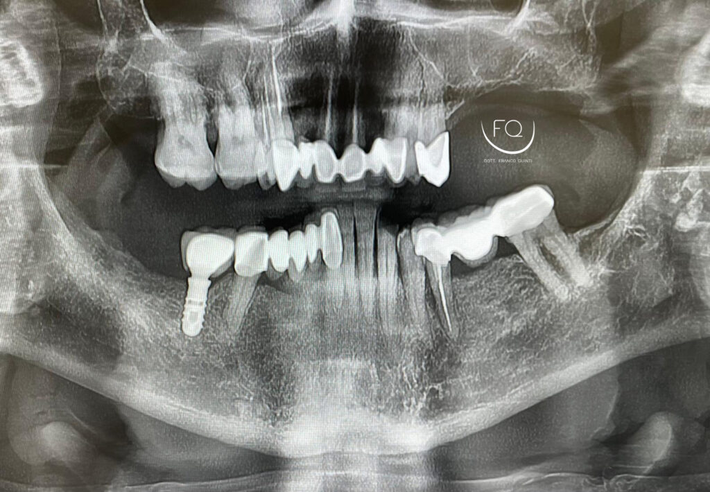 Chirurgia Guidata con Dima scomponibile - 1