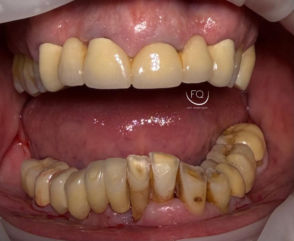 Chirurgia Guidata con Dima scomponibile - 2