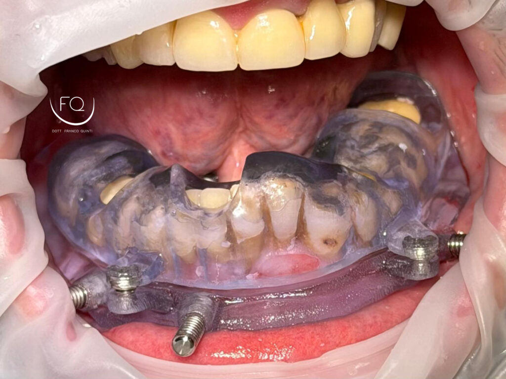 Chirurgia Guidata con Dima scomponibile - 3