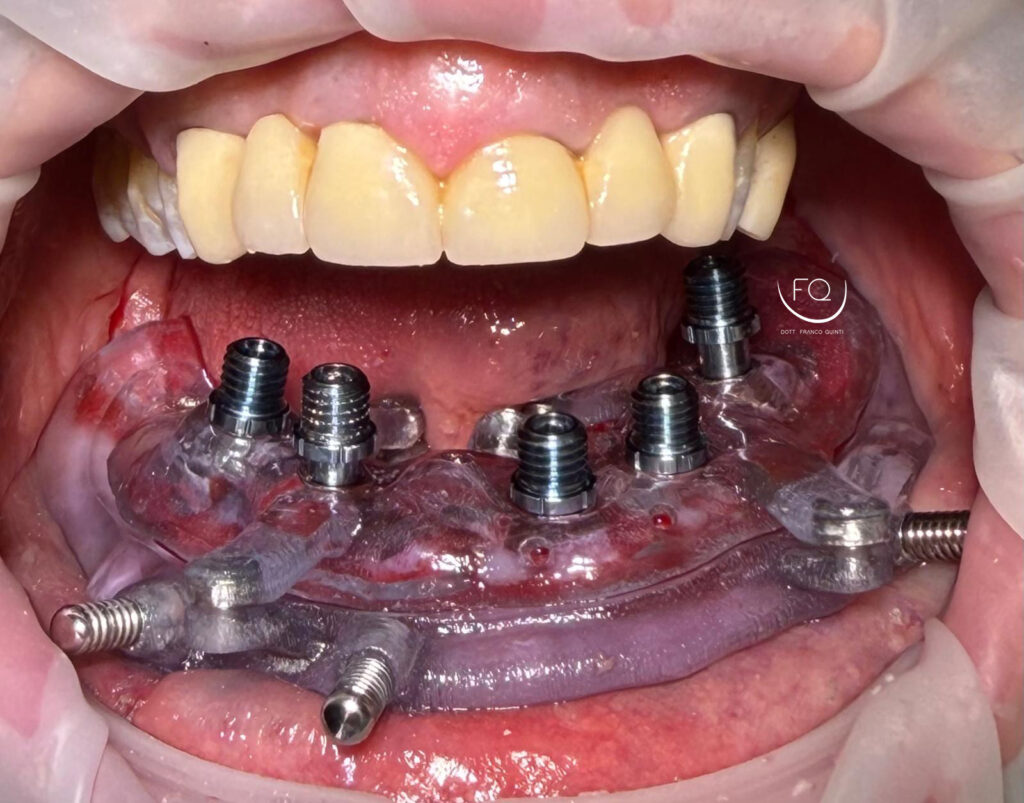 Chirurgia Guidata con Dima scomponibile - 6